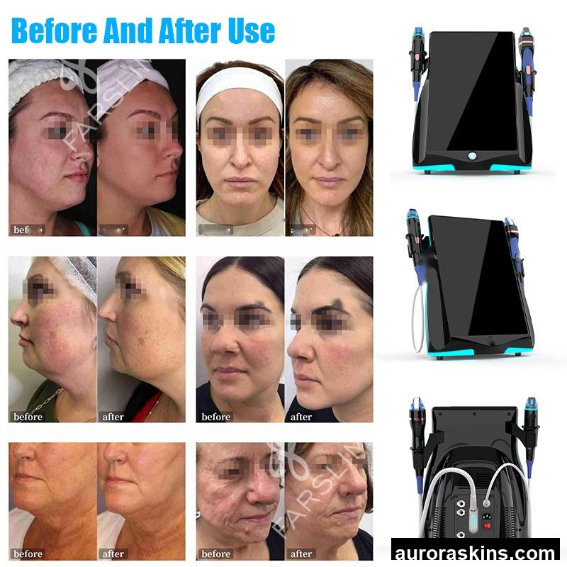 M9 Microcrystalline Anti Aging Machine Acne Scar Treatment 15.6 Inch Touch Screen Skin Tightening Ice Gold Microcrystal Machine
