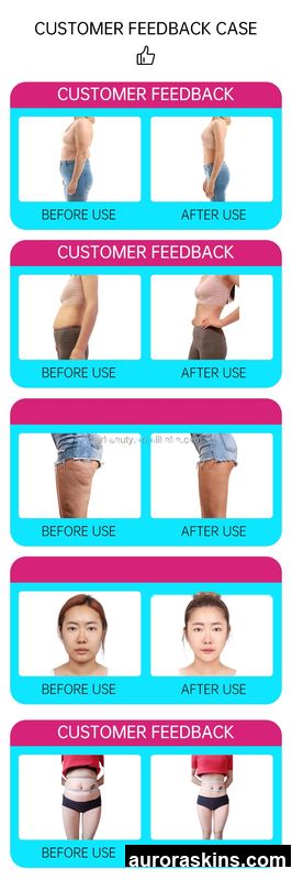 2026 Aurora Skins Firm Sagging Areas, Rejuvenate Muscle Cells, Achieve Tightening & Lifting