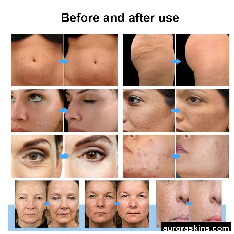 OEM ODM Fractional M8 Facial Rejuvenation Micro Wrinkle Removal Stretch Marks Removal Anti-wrinkle Micro Machine