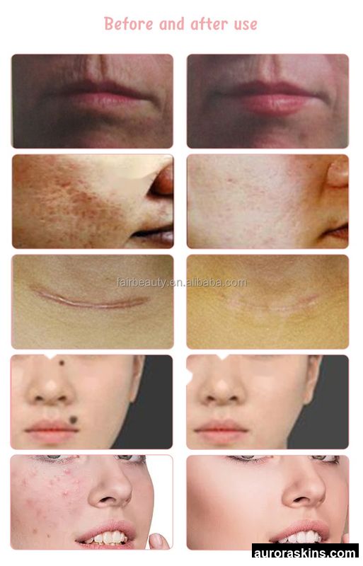 2026 Aurora Skins Multifunctional Anti-Aging Fractional CO2 System-Skin Renewal, Scar & Pigment Reduction, and Stretch Mark Treatment