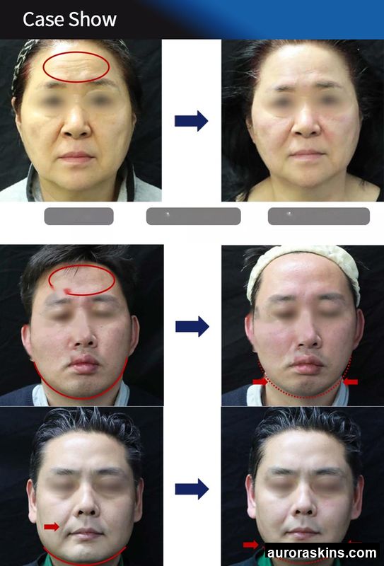 Face Lifting & Skin Rejuvenation Unit-Portable 2-in-1 Anti-Aging Tool, Wrinkle Smoothing, Firming-For Salon Use