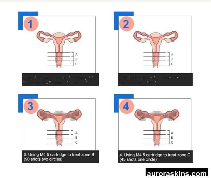 Aurora Skins a Massage Vaginal Homeuse Spa Breast Butt Tightening 3.0mm 4.5mm Firming Machine 2 Cartridges Body Shaper 7D 12D Slimming