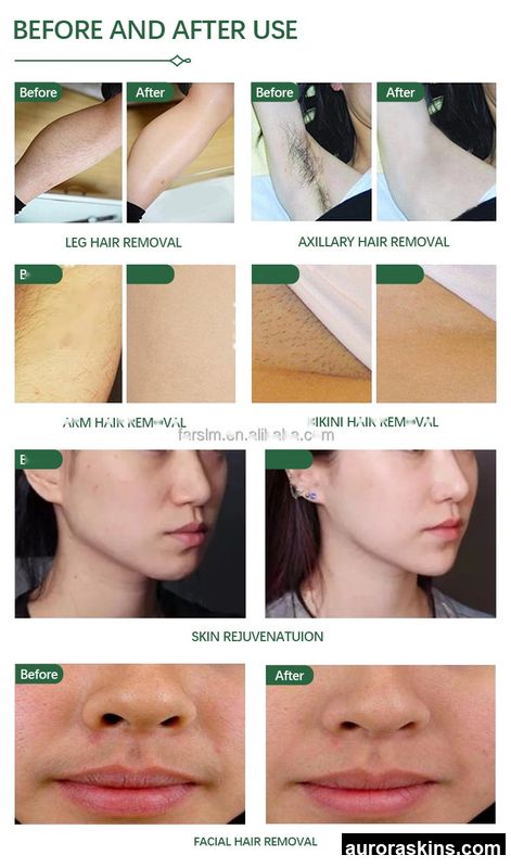 2026 Aurora Skins Dual-Applicator 808nm Photonic Skin & Hair Unit-Skin Refinement + Hair Reduction + Tattoo Fading