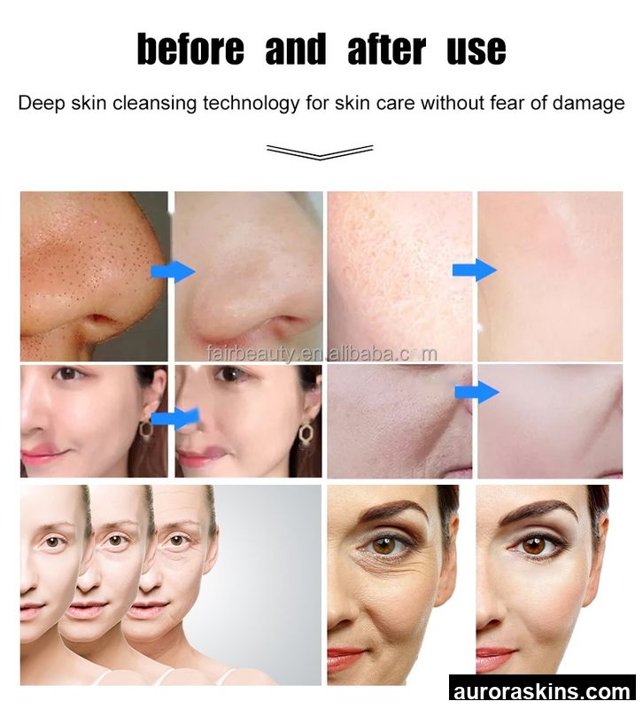 Small Bubble Microdermabrasion Oxygen Jet Facial Care Skin Rejuvenation Machine Blackhead Removal Dermabrasion Facial Machine