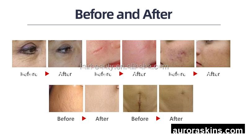 Professional Fractional CO2 Laser Scar Removal & Vaginal Treatment Machine Facial Acne Treatment Beauty Equipment for Salon
