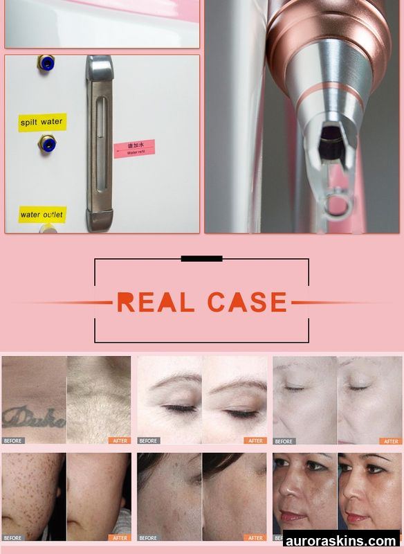 3-in-1 Magneto-Optical System-1064nm Ultrafast Photon+Light+Thermal-For Hair Reduction & Full-Spectrum Treatment.