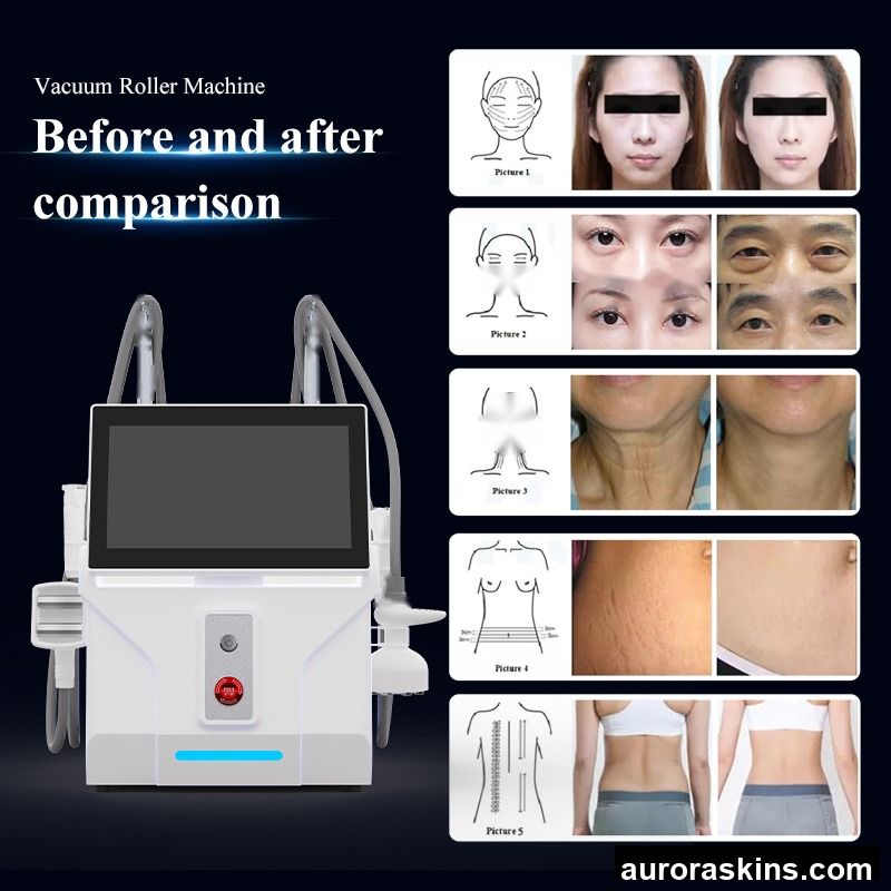 Negative Pressure Inner Roller Lymphatic Drainage Negative Pressure Inner Roller Body Slimming S Shape Machine