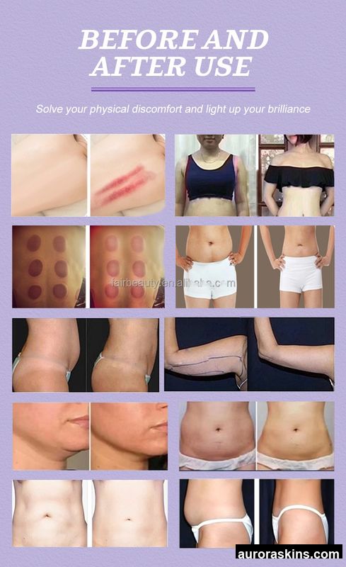 2026 Aurora Skins High-Grade G5 Oscillation Skin Tightening System-Multi-Zone Body Shaping Massage Unit with Deep Tissue Treatment