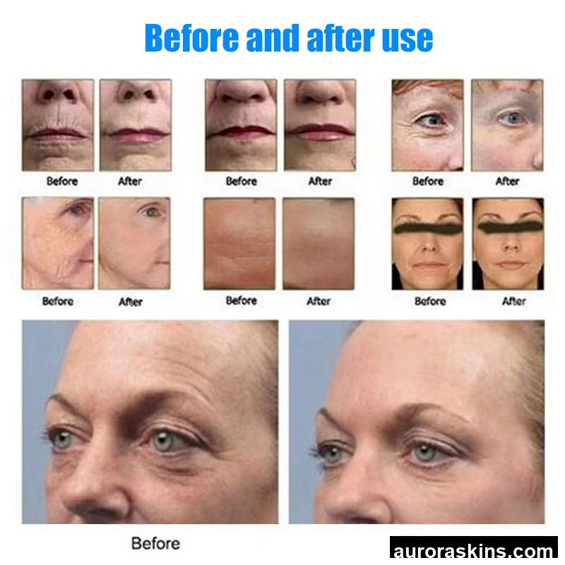 Anti-aging Portable 5D Skin Tightening Wrinkle Removal Facial Machine SMAS Lifting for Home Use