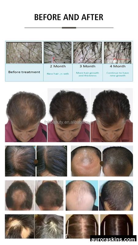 2026 Aurora Skins Premium Desktop LED Hair & Scalp Health Device with US Plug, Cooling System, and Hair Growth Therapy