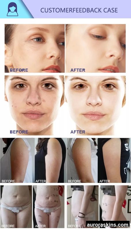 Salon Professional Body Shaping Equipment-Eliminates Cellulite, Reduces Weight, Firms Skin, and Contours the Body (Factory Sale)
