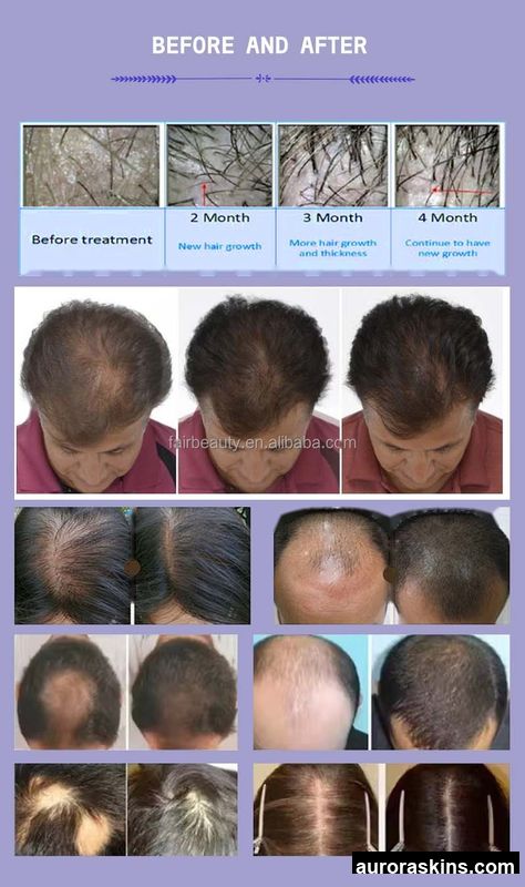 Hair Growth 650nm Hair Loss Scalp Treatment Machine Hair Regeneration 650nm Red Light Therapy Skin Analyzer Machine