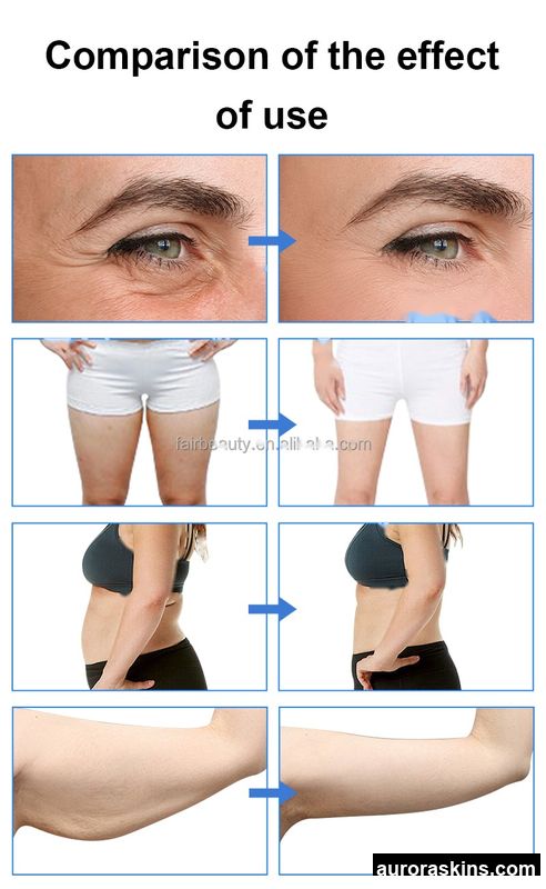2026 Aurora Skins RET Monopolar Indiba Thermal Skin Rejuvenation and Body Contour System (Factory Direct)