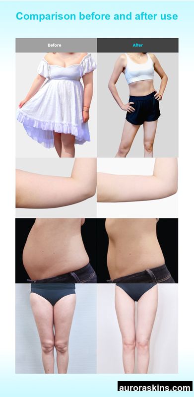 Multi-Function 448kHz Beauty Equipment for Personal Skin Care and Wellness Applications Used to Remove Orange Peel Tissue