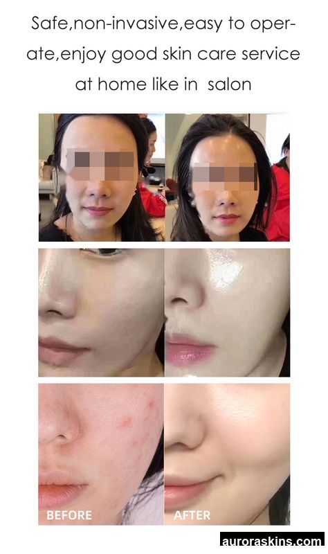 Factory Direct Sales Portable Needle-Free Microcrystalline Skin Rejuvenation Device-Wrinkle Removal, Meso-Infusion Therapy