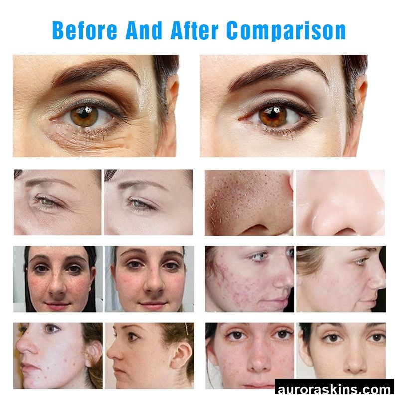 Microdermabrasion Aqua Peeling Machine Blackhead Removal Oxygen Jet Oxygen Facial Dermabrasion Deep Cleaning H2o2 Machine