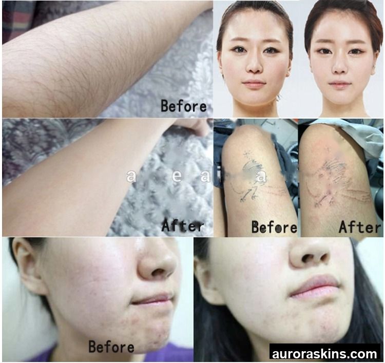 2026 Aurora Skins Handheld 3-Function ABS Beauty Device-Unwanted Hair Management, Dermal Plumping, and Ink Lightening