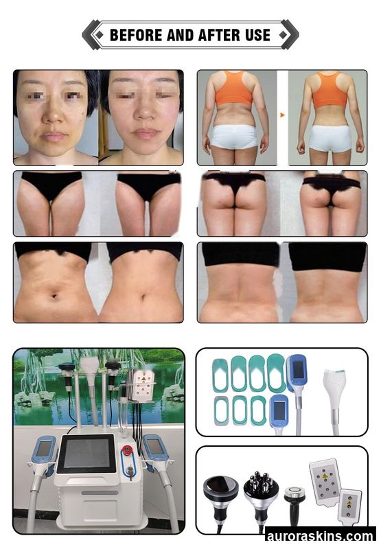 Aurora Skins Choice Desktop 3*360 Degree Cold Body Contouring Cellulite Reduction Machine-Vacuum Therapy for Aesthetic Medicine
