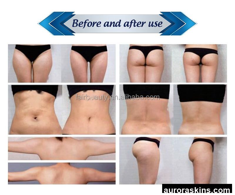 Aurora Skins a 9in1 Artimel Aesthetic 5handles 360degree Cryolipo Cavitation Cool Cellulite Cryo RF Lipolaser Slimming Machine