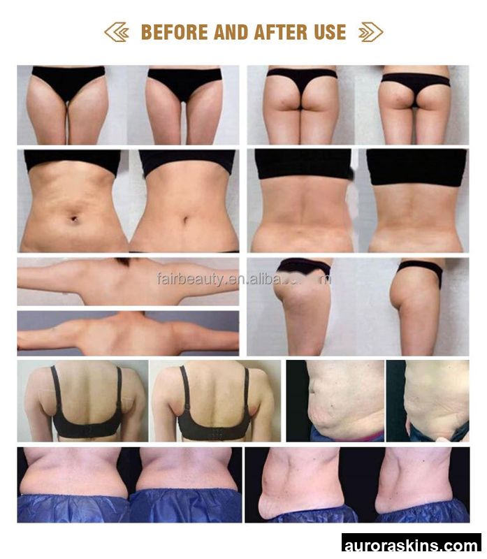 2026 Aurora Skins 4in1 Low Temperature Body Contouring Machine Non-Invasive Cold Therapy for Fat Reduction and Slimming