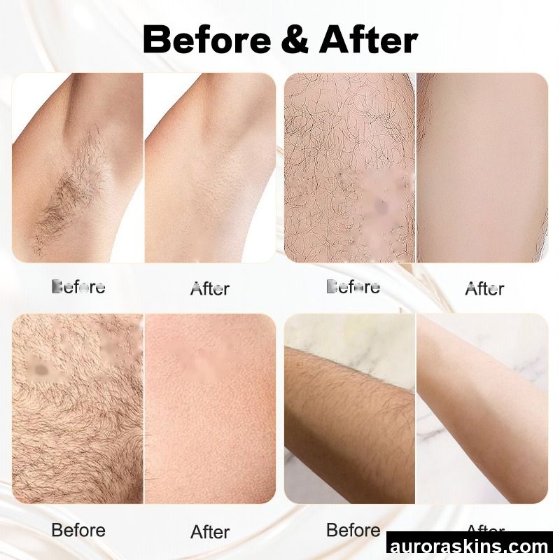 Skin Rejuvenation Permanent Painless Hair Removal Permanent OPT Hair Removal Laser Machine