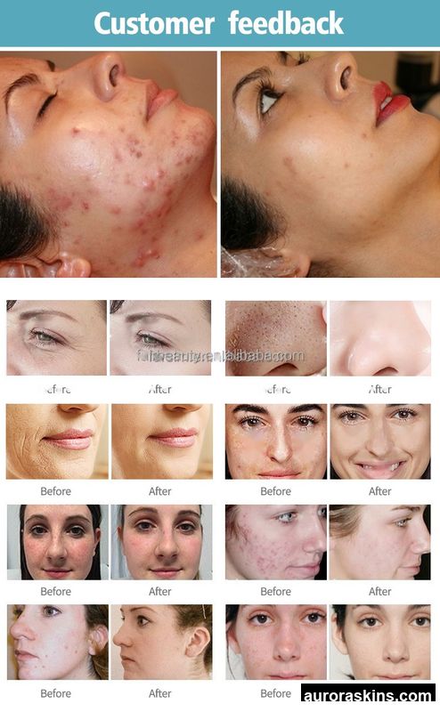 2026 Aurora Skins Fractional CO2 Energy Device for Scar Reduction & Skin Renewal-Professional Grade, Highly Rated