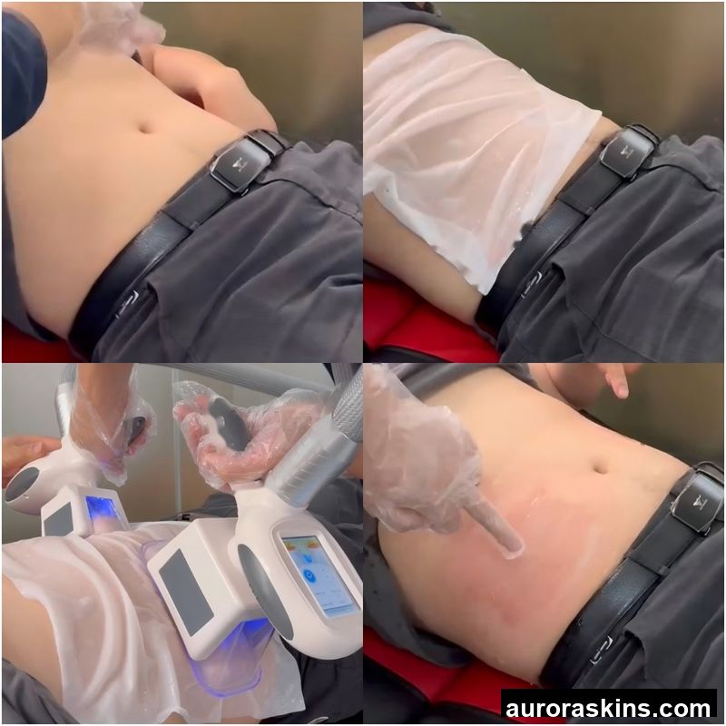 Aurora Skins a 3in1 Face Lift Homeuse Loseweight Beauty Body Shape Vacuum Cupping Ice Cool Slimming CRYO Firming Sculpting Spa Skincare