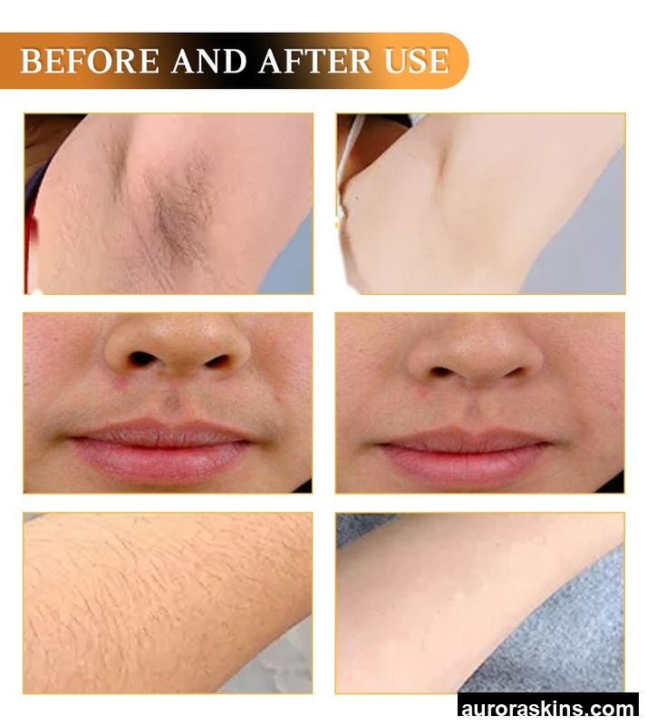 2025 Newest Ice Titanium Laser Hair Removal Diode Laser Hair Removal Machine Professional Permanent Hair Removal Price