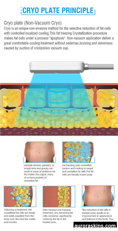Aurora Skins a 3IN1 RF CRYO Slimming PADS 4 Handles Fat Freeze Cryolipollyss Beauty Equipment Factory Price Cryo Spa Beauty Freeze